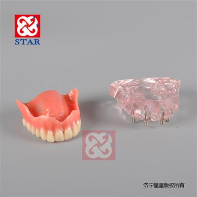 4個微型種植釘，上頜一尺修復(fù)。M6001